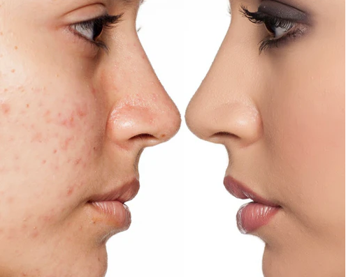 Refine & Clarify Acne Treatment