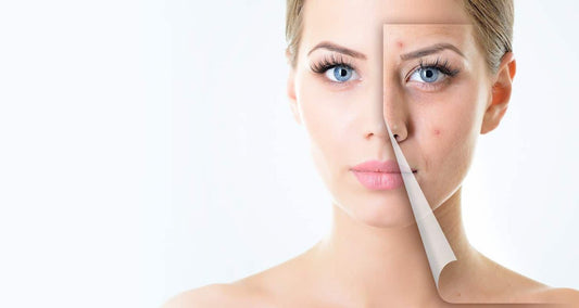 Acne & Pimple Treatment