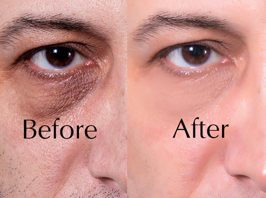 Dark Eye Ring Treatment