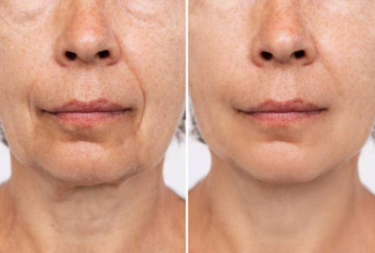 Micro-Face-Lift Treatment