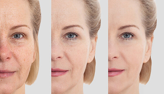 Rejuvenation Facial